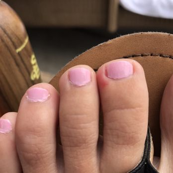 A N Nails - My infected toe following my pedicure here. Beware! I had to go on antibiotics. - Skin Care Near Me - Palos Verdes Peninsula, California