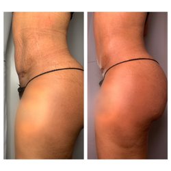 Glo Body Sculpt & Spa - Mini Tummy Tuck- Post-op massage