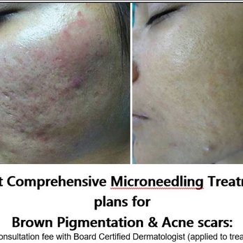 Louise H. Stewart, MD - MicroNeedling: Hyaluronic Acid, Lightening Serum or PRP. Automated Micro-Needling (also known as Collagen Induction Therapy of CIT) - Dermatologists Near Me - Santa Barbara, California Louise H. Stewart, MD - MicroNeedling: Hyaluronic Acid, Lightening Serum or PRP. Automated Micro-Needling (also known as Collagen Induction Therapy of CIT) - Dermatologists Near Me - Santa Barbara, California
