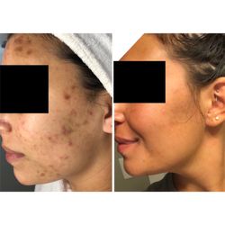 Acne Specialists of Nashville - Booking: nashvilleacne.com