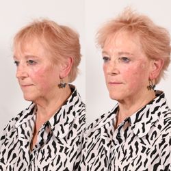 The Haute Beauty Clinic - Lifting threads and density rf
