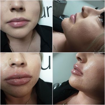 LBC Laser MD - Lip fillers - Laser Hair Removal Near Me - Long Beach, California LBC Laser MD - Lip fillers - Laser Hair Removal Near Me - Long Beach, California