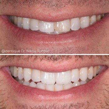 Dentique - One veneer. - Cosmetic Dentists Near Me - San Diego, California