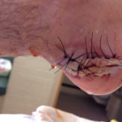 Reconstructive Foot Surgeon - Partial calcanectomy due to decubitus chronic ulceration heel