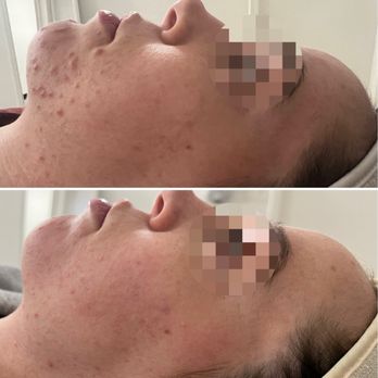 Skincare by Jasmine - After 2 sessions of TCA peel (10%) - Skin Care Near Me - New York, New York Skincare by Jasmine - After 2 sessions of TCA peel (10%) - Skin Care Near Me - New York, New York