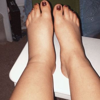 Mendez & Sanchez - Swelling from broken ankle - Personal Injury Law Near Me - Los Angeles, California