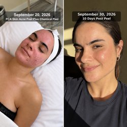 Esthetics by Roxanne - This is an actual result, no AI. If you have acne concerns...415.655.9769