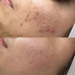 Bare Complexion - Acne skincare treatments for acne scars located in Ventura,Ca at Bare Complexion Acne & Skincare with Stephanie Vega.