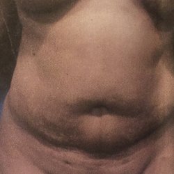 Peter Vail Driscoll, MD - Beverly Cosmetic Surgery Institute - Ugly flabby chunky