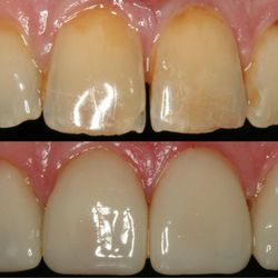 Adomian Garo, DDS - Same day smile makeover utilizing CEREC one visit dentistry