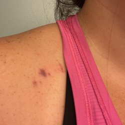 Countryside Surgery Center - Bruise from nurse