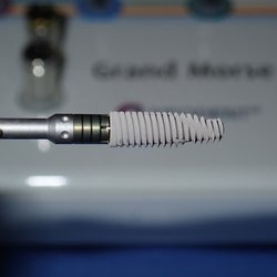 Sam I Naim, DDS - Periodontics & Dental Implant Center - Implant fixture. Titanium implant that is installed in the jawbone prior to crown being fabricated.