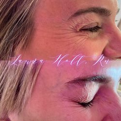 The Aesthetics Boutique - Crows Feet (Smile Line) Tox