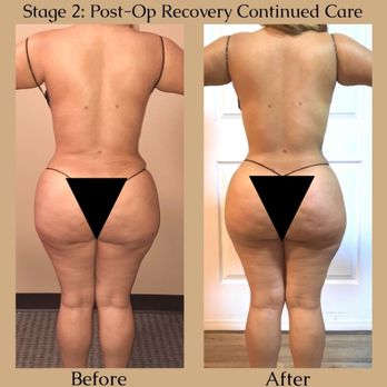 Phynix Rising - Sculpt &Contour for lipo client - Massage Therapy Near Me - Houston, Texas
