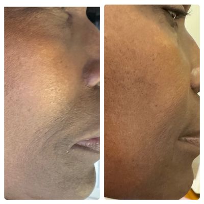 Hydrafacial - This is one treatment with the hydrafacial machine. Hydrafacial - This is one treatment with the hydrafacial machine.