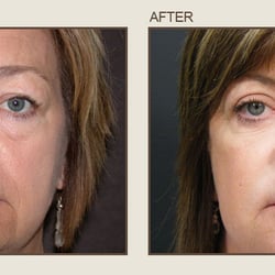 Center For Eye & Laser Surgery - Before & After
Center for Eye & Laser Surgery- Severna Park, Maryland