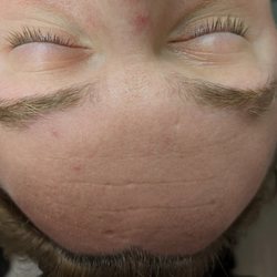 Serene Sage Spa - Before Microdermabrasion