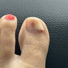 Bad pedicure caused my toe nail to fell off!