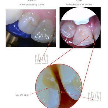 Smiles Dental Studio - Tooth surprisingly chipped in an area above bite pressure after dentist visit. - Cosmetic Dentists Near Me - Sacramento, California