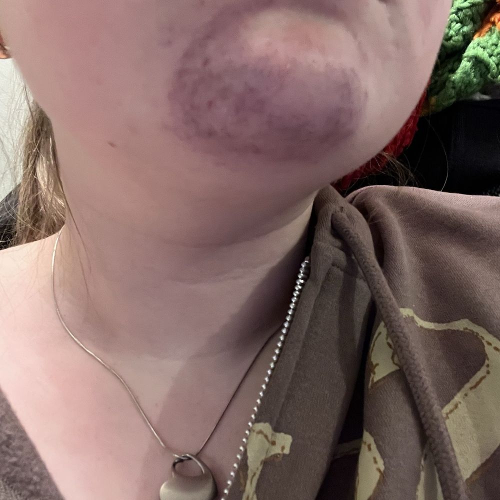 Advanced Oakdale Dental - Other angle of bruising - General Dentistry Near Me - Dedham, Massachusetts