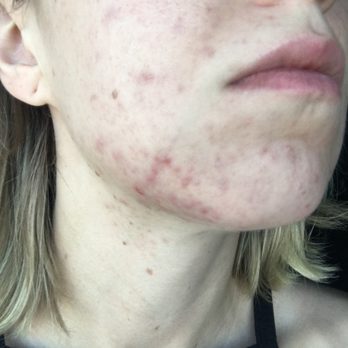 Skin by Jane Mann - Before - Skin Care Near Me - Las Vegas, Nevada Skin by Jane Mann - Before - Skin Care Near Me - Las Vegas, Nevada