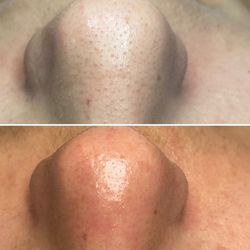 Nüskin Facial Spa - Before and after
