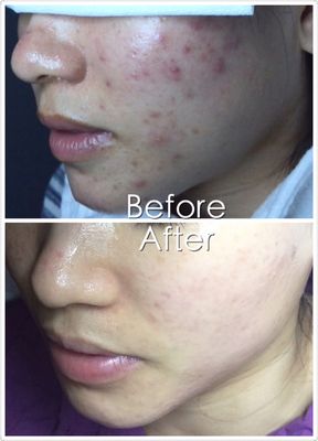 Seaweed Skin Renewal Peel - +Result shown on these clients in 2 months. Result might vary.
* SEAWEED SKIN RENEWAL PEEL *
Cell renewal accelerating treatment with the help of Seaweed micro-sponge to accelerate blood circulation and boost Epidermal Cell proliferation. This treatment will help remove dead keratinocytes and eventually renew skin to look more healthy, re-densified, lifted, glowing and youthful with even complexion.
Key Benefits:
• Minimizing pores
• Smoothing wrinkles
• Combating acnes and scars
• Enhancing lifting and firming
• Improving skin complexion Seaweed Skin Renewal Peel - +Result shown on these clients in 2 months. Result might vary.
* SEAWEED SKIN RENEWAL PEEL *
Cell renewal accelerating treatment with the help of Seaweed micro-sponge to accelerate blood circulation and boost Epidermal Cell proliferation. This treatment will help remove dead keratinocytes and eventually renew skin to look more healthy, re-densified, lifted, glowing and youthful with even complexion.
Key Benefits:
• Minimizing pores
• Smoothing wrinkles
• Combating acnes and scars
• Enhancing lifting and firming
• Improving skin complexion