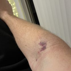 BioLife Plasma Services - Second hematoma on my right arm