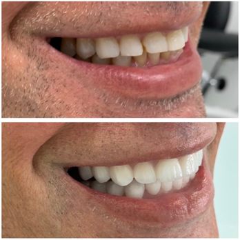 Sher Dental - Full mouth smile makeover - Cosmetic Dentists Near Me - North Miami, Florida Sher Dental - Full mouth smile makeover - Cosmetic Dentists Near Me - North Miami, Florida