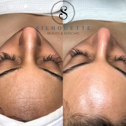 Before and after Platinum Microdermabrasion