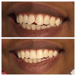 Eklea Cakuli DDS - Chipped front teeth- Restored with Bonded fillings