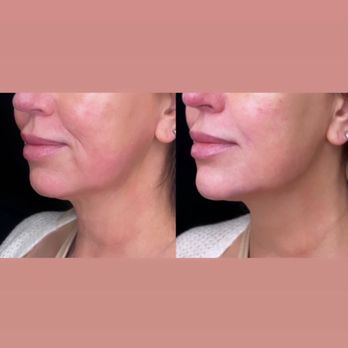 SkinSpirit - North Austin - Lower facial balancing - Skin Care Near Me - Austin, Texas SkinSpirit - North Austin - Lower facial balancing - Skin Care Near Me - Austin, Texas