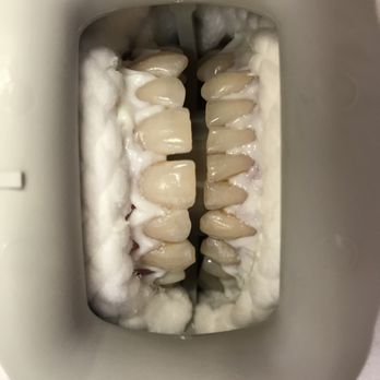 David Guyot, DDS - Tustin Smiles - Zoom whitening Before - General Dentistry Near Me - Tustin, California David Guyot, DDS - Tustin Smiles - Zoom whitening Before - General Dentistry Near Me - Tustin, California