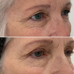 Minnesota Ophthalmic Plastic Surgery Specialists - Upper us before and lower are after.