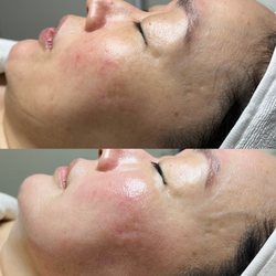 Pure Aroma Skincare - Superjection treatment (Retinoid)