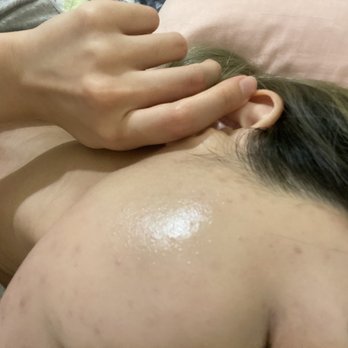 ES Skin Care - After the 10times acne package - Skin Care Near Me - Buena Park, California