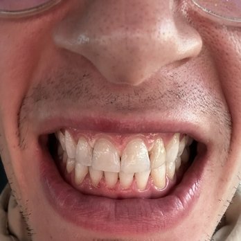 Fuller Smiles - After whitening - General Dentistry Near Me - Long Beach, California