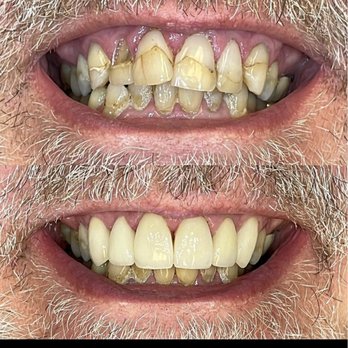 Berkeley Hills Dentistry - Six Front Veneers - General Dentistry Near Me - Berkeley, California