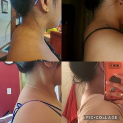 Integrity Chiropractic - Top-left (beginning) to bottom-right (end results). Improvement in neck hump over the course of a couple months w/ Dr. F's at-home HW.