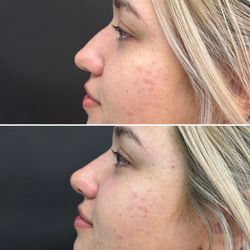 Clinic Maren - Liquid nose Job