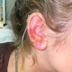 Silver Secret - My infected ruined ear.