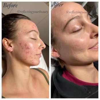 Reflecting Your Beauty - Severe acne to clear skin in under 3 months. - Skin Care Near Me - West Palm Beach, Florida Reflecting Your Beauty - Severe acne to clear skin in under 3 months. - Skin Care Near Me - West Palm Beach, Florida