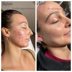 Reflecting Your Beauty - Severe acne to clear skin in under 3 months.