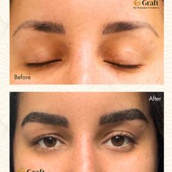Graft Hair Restoration & Aesthetics - Eyebrow Transplant Before and After