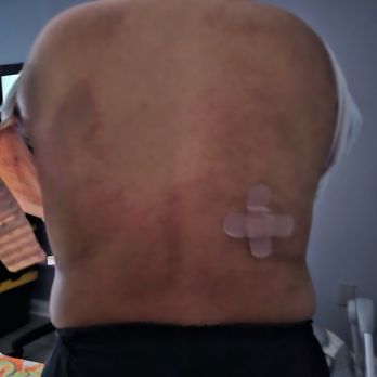 La Peau Spa & Laser - My PUPPP rash and bandaid is covering up my stitches. - Skin Care Near Me - Fresno, California La Peau Spa & Laser - My PUPPP rash and bandaid is covering up my stitches. - Skin Care Near Me - Fresno, California