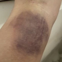 BioLife Plasma Services - A hematoma from plasma donation, caused by a bad injection. It hurt as bad as it looked.