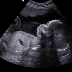 Home Baby Reveal - 2D Imaging