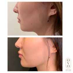 Ovo Medi Spa - Facial Contouring is a very popular treatment.  This lovely lady had chin filler, Botox TMJ, and lip filler to enhance her beauty.