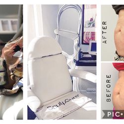 Skin Body Soul - Sculpsure permanent fat removal