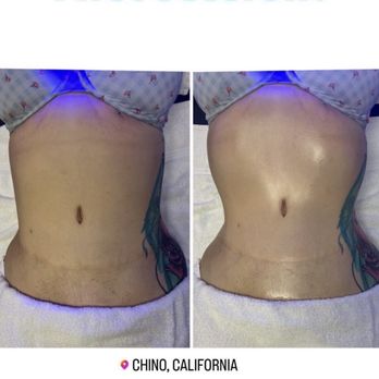 The Beauty Whisperer - This is before and after just one session - Medical Spas Near Me - Chino, California The Beauty Whisperer - This is before and after just one session - Medical Spas Near Me - Chino, California